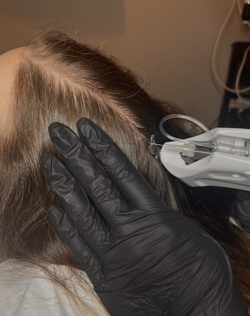 XL hair therapy tegen haaruitval